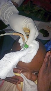 The drainage system is connected and the catheter wrapped with sterile gauze to prevent movement laterally