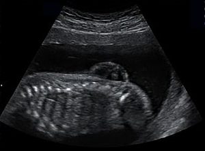 prenatal ultrasound of myelomeningocoel